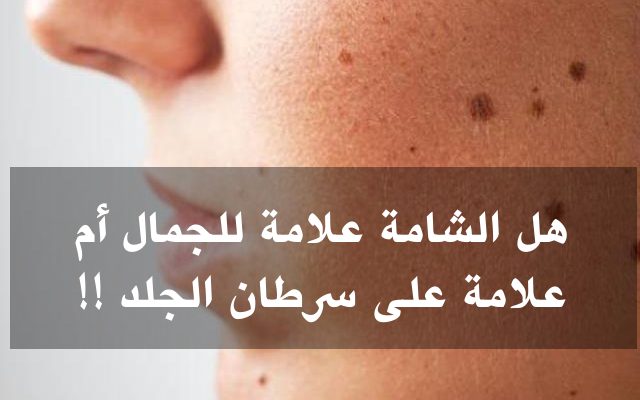 Photo of skin mole might be dangerousالشامات قد تكون خطيرة