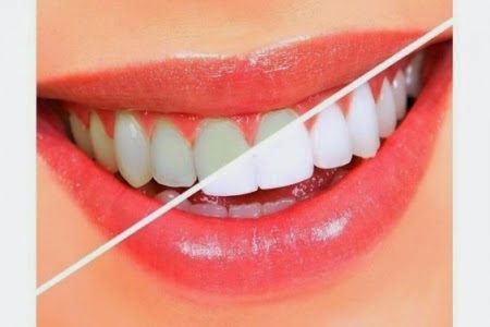 الحل السحرى لمشكلة اصفرار الاسنان