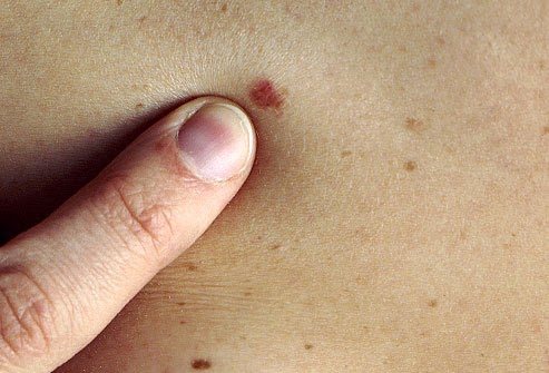 Photo of كيف تفرق بين الشامة العادية وبين سرطان الجلد؟